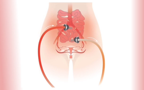 Peritoneal Cancer Surgery